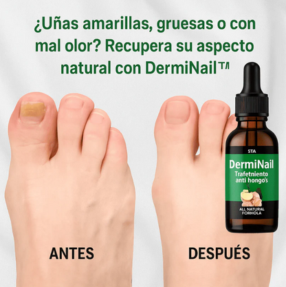 DermiNail ELYON™ – TRATAMIENTO ANTI HONGOS 7 DÍAS 100% NATURAL